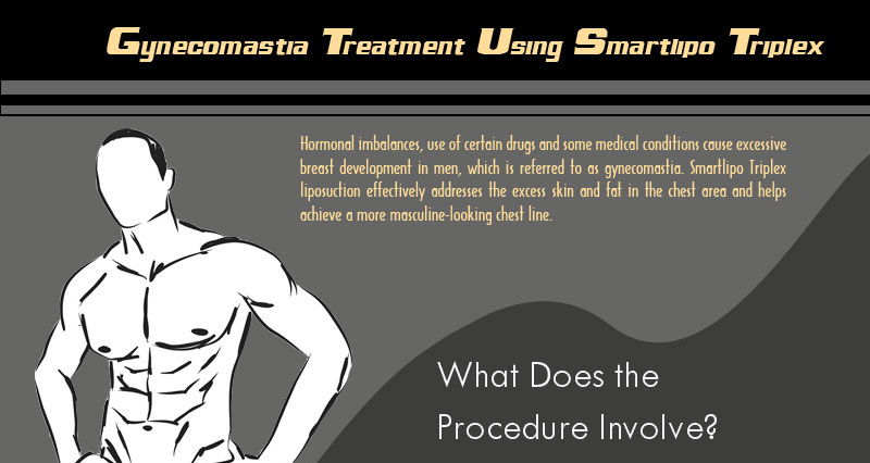 Gynecomastia Treatment Using Smartlipo Triplex [Infographic]