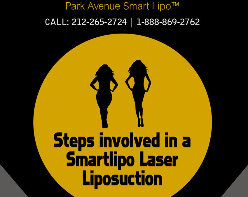 Steps involved in a Smartlipo Laser Liposuction [Infographics]