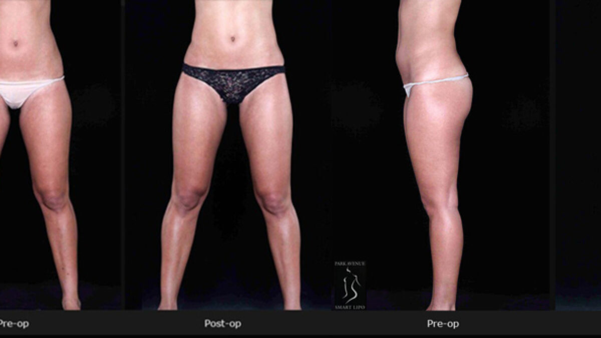 Liposuction After Care  What Not to do After Liposuction