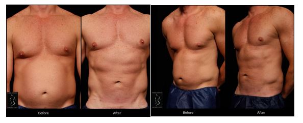 Recovery Tips for Male Abdomen Liposuction in Manhattan