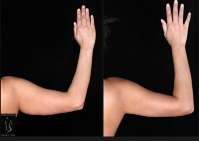 Female Arm Liposuction