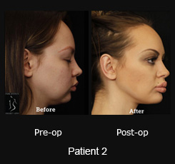 SmartLipo Neck Liposuction - Patient 2
