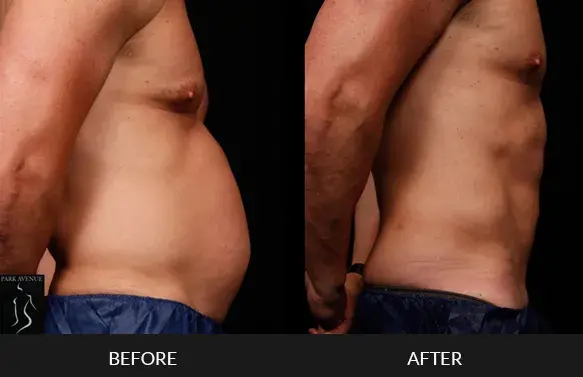 Male Abdomen Liposuction NYC  Abdominal Liposuction For Men