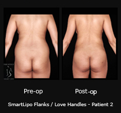 Smartlipo & Vaser for Snatched Waist & No More Love Handles! Before & After  Photos New Jersey - Reflections Center